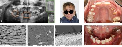 Oral Phenotype of Singleton–Merten Syndrome: A Systematic Review Illustrated With a Case Report